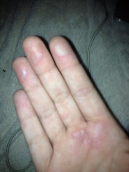 My poor hand after a coffee mug handle melted off in it - ill need trust them again http://t.co/lk2b<a href="/tag/nostalgia"class="tags"><span>#nostalgia</span></a><a href="/tag/pogs"class="tags"><span>#pogs</span></a>