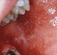 Oj 風疹のコプリック斑 どこにできるか 発赤を伴う粟粒状の水疱 Http T Co 2egq7xtt Oj 風疹のコプリック斑 どこにできるか 発赤を伴う粟粒状の水疱 Http T Co 2egq7xtt