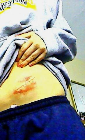 ChasidyAnna's tweet image. my stomach is fucked. #AppendixIsOut!