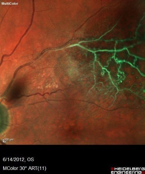 EyeGuyTexas's tweet image. Branch Retinal Vein Occlusion taken in Multi Color Imaging
#VisionExpo #Visions2013 #BRVO #branchretinalveinocclusion