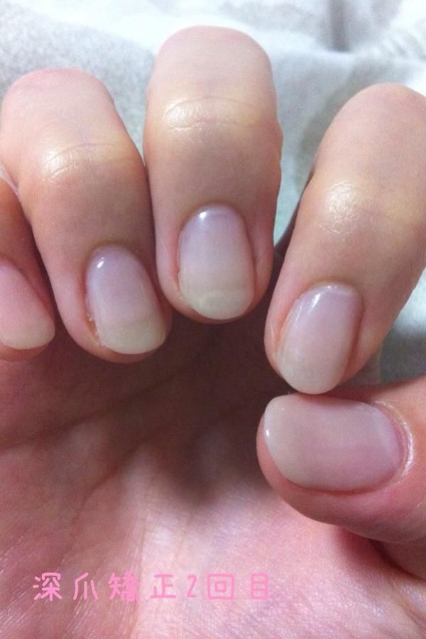 tabimiarara's tweet photo. 爪が変わってきたよ…
【Before】 http://t.co/rkmkE00p