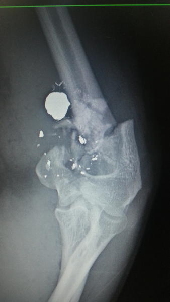 Caso evaluado hoy, Fx x proyectil arma de fuego anoche. Trastornos del nervio mediano, opción para la Fx?