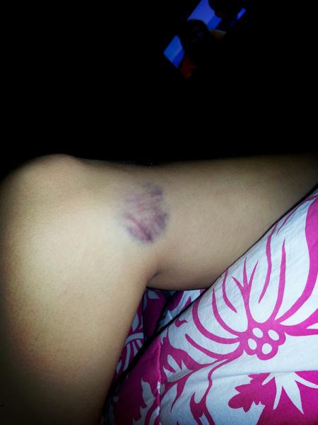 fieldskayalyssa's tweet image. ugly ass bruise.. #hurtslikeabitch