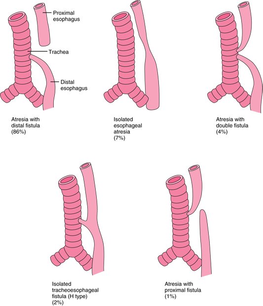 yvrgasman's tweet image. @gasclass type C: prox oesophageal atresia w distal TOF #gasclass