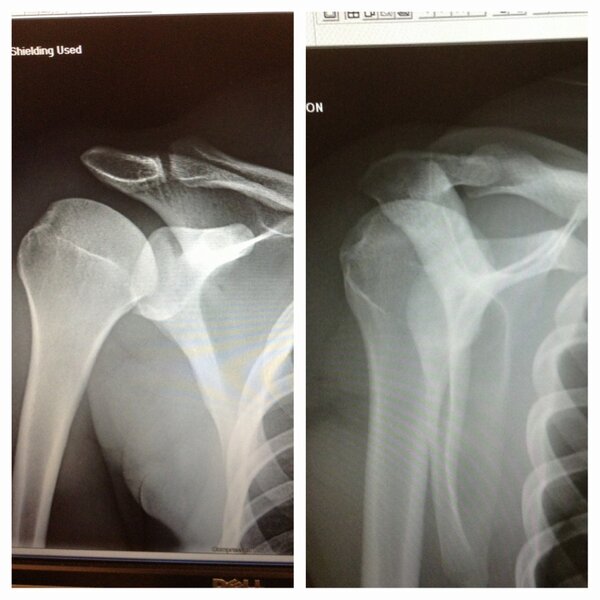 TaylorKeeker's tweet image. Tweet on behalf of @ChadDavidMiller #dislocated  #nowfixed  #beforeafter