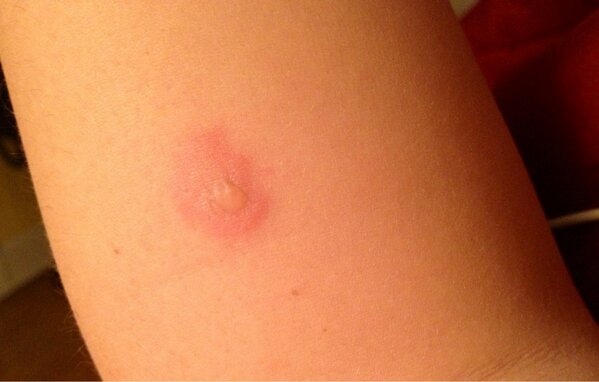 lgrove_27's tweet image. @JoeJoeGavin I guess that cig did more damage than I thought. #ouch #cigburn #pubproblems