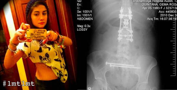 rubiq's tweet image. My entrance for @JoshSundquist contest. I wrote #1mt1mt in my scar: it made me walk again after I broke my L1 vertebra