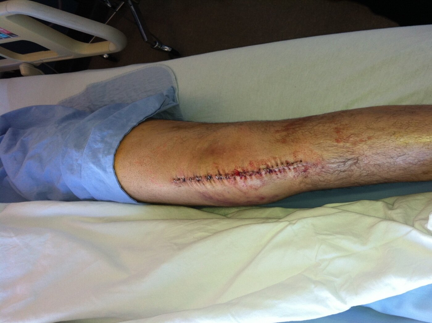 Photo Of Bret Hart's Knee After Surgery + Bret Hart Talks Montreal And Relationship With WWE BCXmegRCYAIdGwj