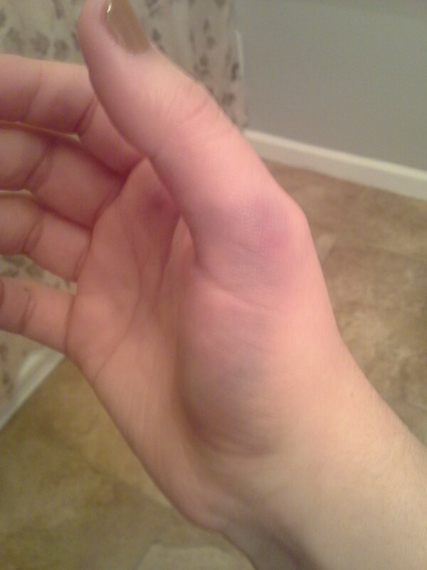__niela___'s tweet image. dat bruise #vbprobs