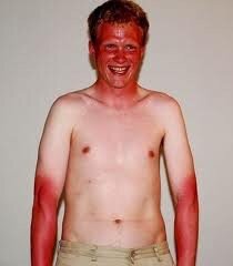 YaBoyGinger's tweet photo. "Bitches love my burns" http://t.co/LL6DGpxXWv