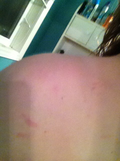 campbellsoupxo's tweet image. Those marks on me ? Oh you know just the finger nail scratches from little girls. #instructorproblems everywhere.