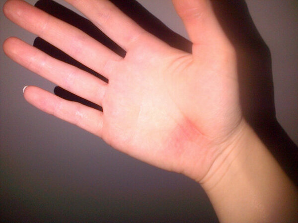 healthygirlll's tweet image. Callous developing on my palms from doing mountain climbers and burpees using the aerobics step! #owchie :(