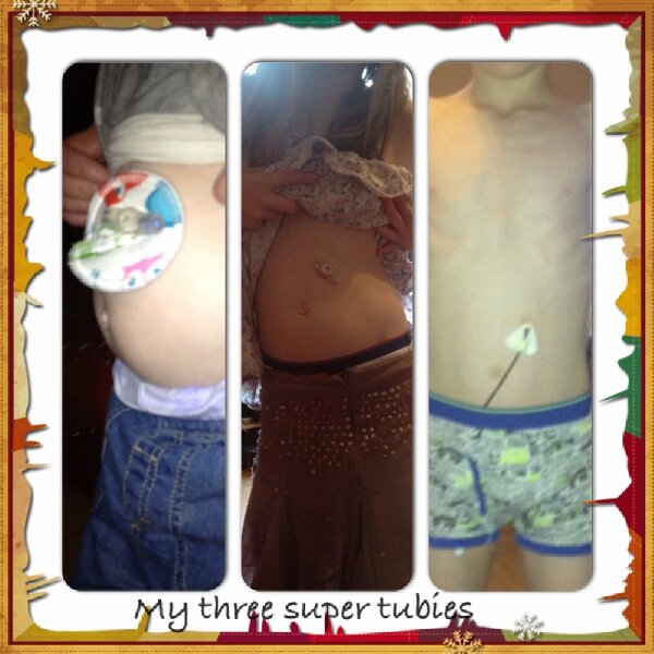 #feedingtubeawareness. Spreading the word about tube feeding. Its the reason my kids are alive and thriving.