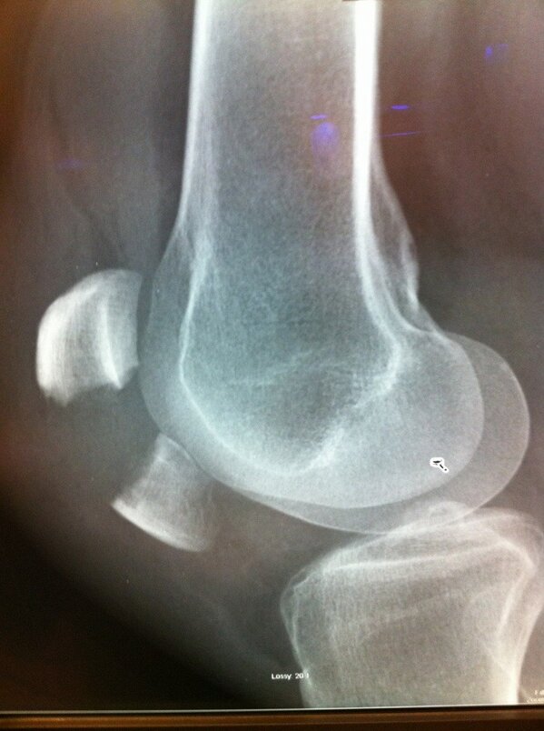 SaraZigman's tweet photo. @lindseyvonn I sympathize!  Broke knee in 1/2 last yr &amp; spent yr in rehab learning 2 walk again.  U can beat this! http://t.co/QGdOGT3z