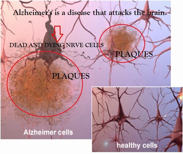 AmericanHeartSa's tweet photo. #AlzheimersDisease on facebook https://t.co/YvfXzuD9tE http://t.co/a0OF3U1qSx