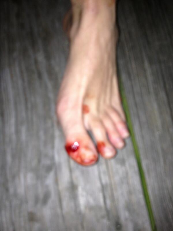 #seasideadventures @ChaseClack #ouch