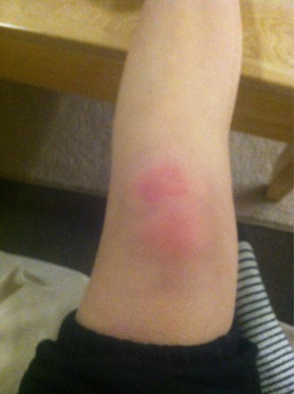 cashewcide's tweet image. I really fucked up my knee #slowlyswelling #hurtslikeabitch