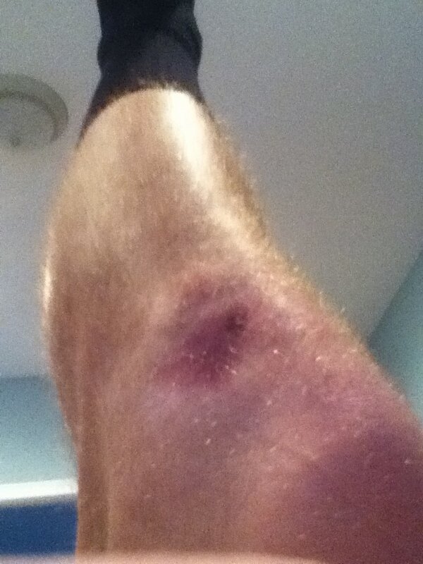 Kevkevgordon's tweet image. Freaking arrow to the knee😉 #vbprobs #volleyball #skyyyyriiimmmm
