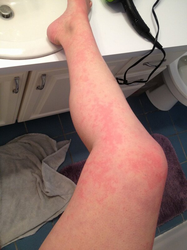 heathercharbsss's tweet image. This is why I fucking hate oranges #alergic