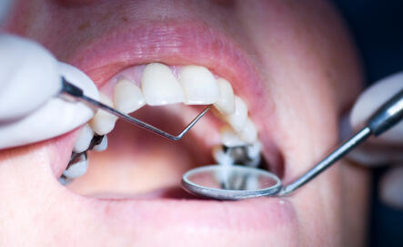 Dental teeth fetish Crackwhore sucking dick