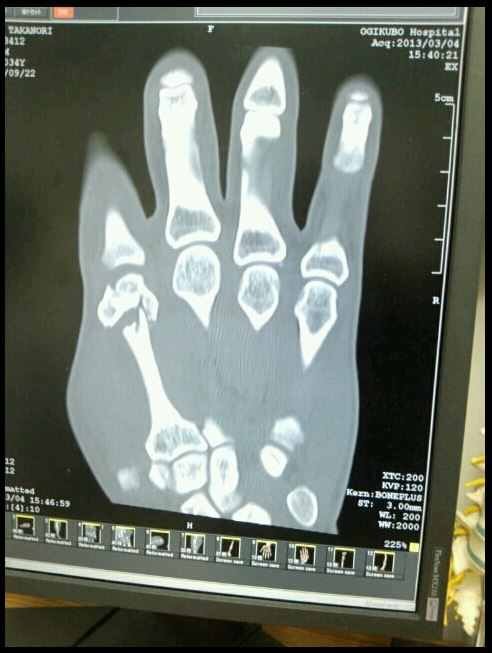 BOXHAUS_GER's tweet photo. Takanori Gomi broke his hand right in the first round in fight with Sanchez. #ufc #xray #gomi #sanchez http://t.co/VJ9On3MiD3