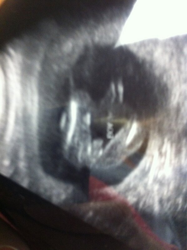 stephchoate's tweet photo. Looks like we are having a boy! #excited @LSapp_12 http://t.co/nIlae9sTzR