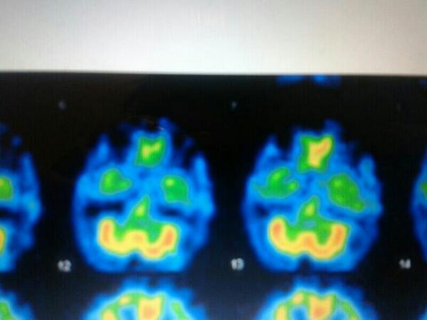 javimolcal's tweet image. ¿Spect de perfusión cerebral o caritas felices? :3 #studynonstop