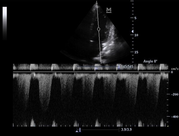 Sonocloud's tweet photo. Sonocloud image of the day - CW Mitral Regurge - http://t.co/0YNHLUtT2W - Uploaded by Mallin - #FOAMed http://t.co/CYS5SQIPUj