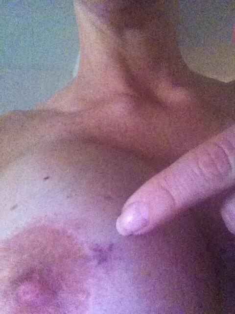 Got a hickie http://t.co/wEDa2haqOj