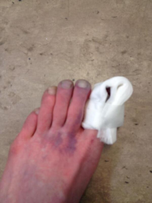 DownesDaniel's tweet photo. #KissXperiaZ   this defines my day run over my foot with a drinks cage :( http://t.co/irkl3mYVx4