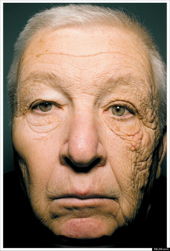 _AmazingPhotos's tweet photo. This is a lorry driver of 20yrs who has sun damage to the side of the face which faces the window. Mindblowing! http://t.co/UaIC4fYEd2
