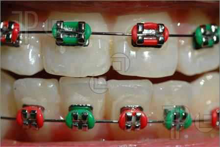 BrookeSherrell's tweet photo. Retweet  If you have Braces ,Know someone with them ,Or Need them ~!! 
I Have Them ^_^ http://t.co/YoY3EWJVMO