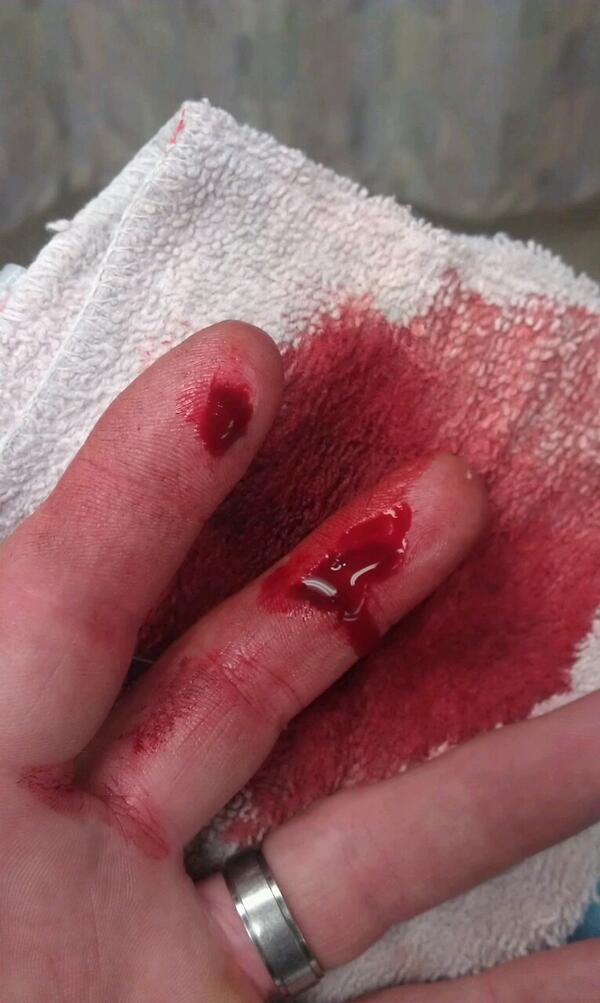 daalse's tweet image. Still bleeding...