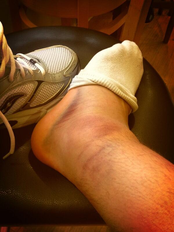 samcob7's tweet image. On the mend??? #quickreturn #break