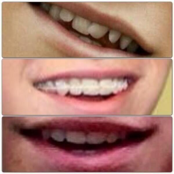 Before And After Braces Niall Horan