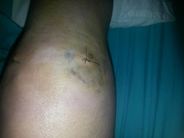 lizziechic03's tweet photo. Ahhh I have no knee cap http://t.co/WiMCslaY2x