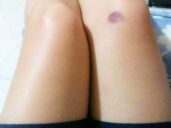 LunatiCarla's tweet image. Yung nagkapasa at nagkasugat even before i got drunk! Haha #DSPalumni #eastersunday #lateupload #Shunga