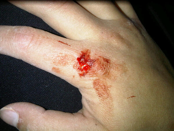 Livii_P's tweet image. Ouchie #hikingproblems