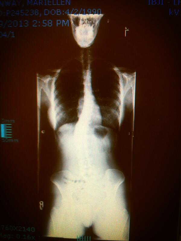mare_benway's tweet photo. Doctors appt only need physical therapy yay! #curvyback #xray #scoliosis http://t.co/bRRgiRSchL