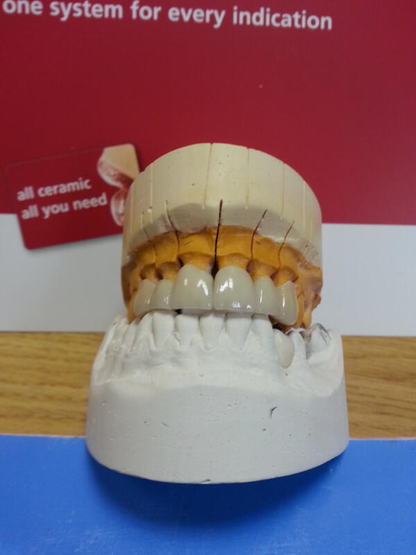 rootsdental's tweet image. Another 6 Emax leaving the building today #whyuseanythingelse #bestaestheticsinthebusiness