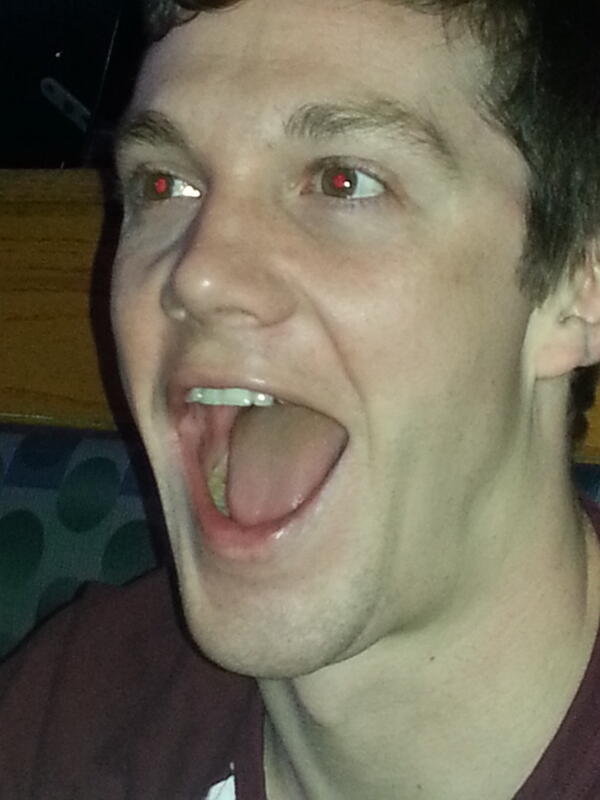 DrPoopers's tweet image. #dsf dickhole sucking fracture...  @cpogonch says it deviates to the #contralateral side