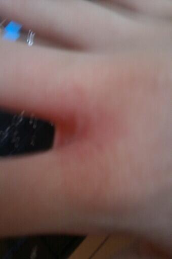 SarahChocolate3's tweet photo. burned hand :( http://t.co/Lb3ggu1j5Y