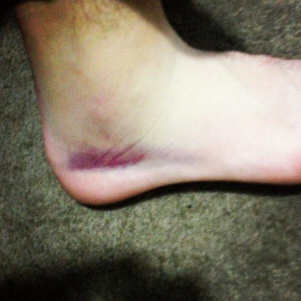 randomu70411665's tweet image. Busted up ankle. I don't think I was built for basketball. #whiteguyproblems