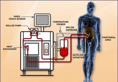 HIPECTreatment's tweet image. 