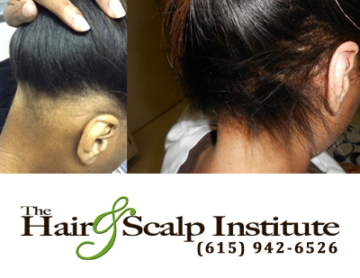HSINashville's tweet photo. Isn't it good to know there is a hair re-growth option that actually works? Call us today t... http://t.co/7shCvOMo3a http://t.co/OaMcZDjxMk