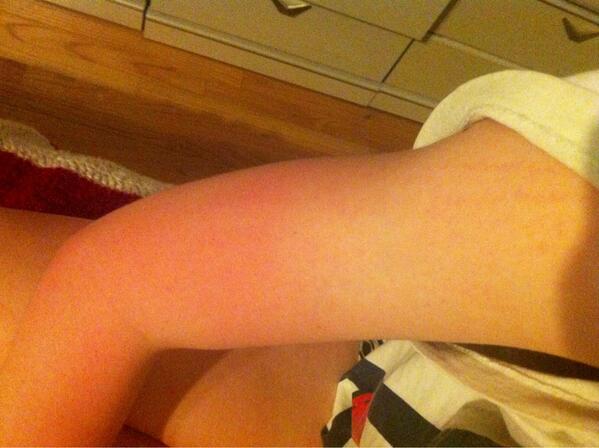 madehhline's tweet image. Wait no why am I so burned?!? I put sunscreen on!! -.- #farmerstan #trackprobz