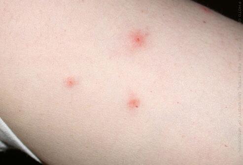 FryePestControl's tweet photo. Here are some examples of what a bite from a bed bug can look like. #bedbugs #bites #pest #insect #exterminate http://t.co/CtNgSCrWL6