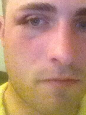 SeabassDan's tweet photo. “@RugbyDiehards: A black eye given by Rugby is highly fashionable.” http://t.co/0o3MqUd7xo