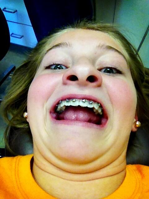 Gabie_Lou25's tweet image. Look who's a brace face now... #loveyou #braces #sucksforyou @niksadele