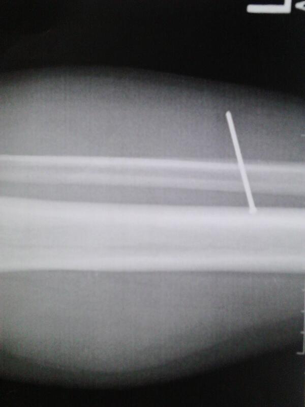 rrogertravis10's tweet photo. I accident shots my self last Friday I got very lucky it didn't go in my bone http://t.co/1ck9xAAJv3